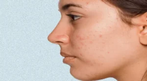 Acne prone skin and its characteristics