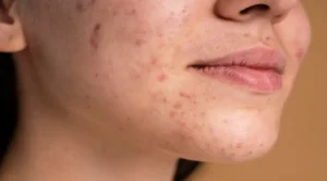 Tips for acne prone skin